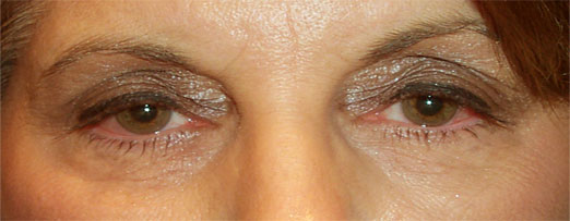 Ptosis — drooping upper eyelid margin partially covering the pupil