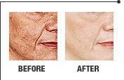 Skin Rejuvenation