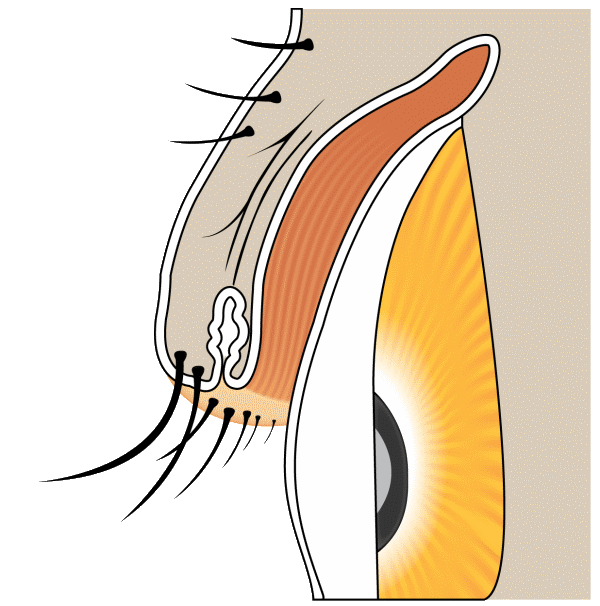 Diagram of normal eyelash direction curving away from the eye